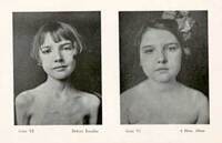 Photo of a typical juvenile diabetic before and after treatment (T10028_0233)